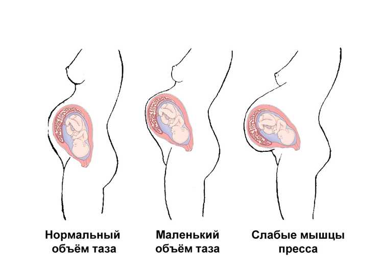 Прогноз и план ведения при НМПК 1А стадии