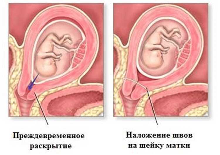 Как правильно подобрать и установить изделие для поддержки шейки матки самостоятельно