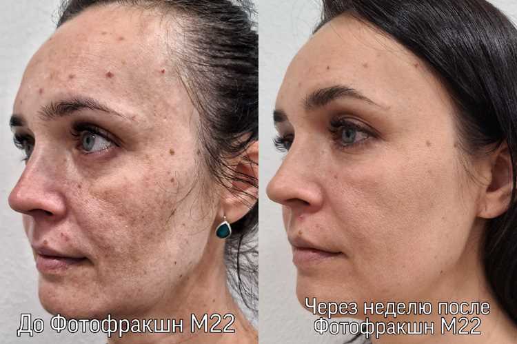 Домашние способы осветления темных участков кожи, одобренные врачами